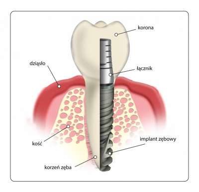 Implanty zębowe - usługi stomatologiczne Dentical w Kaliszu