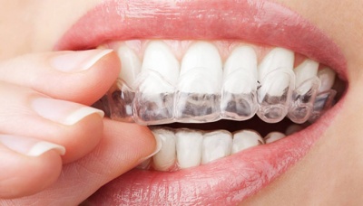 Wybielanie zębów - stomatologia estetyczna w Dentical